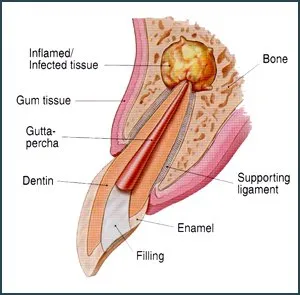 Why would I need Endodontic Surgery?