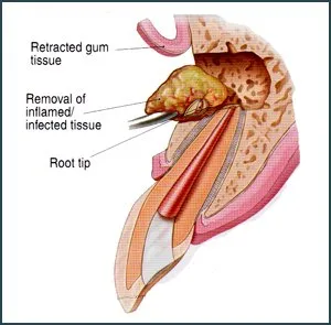 What is an Apicoectomy?