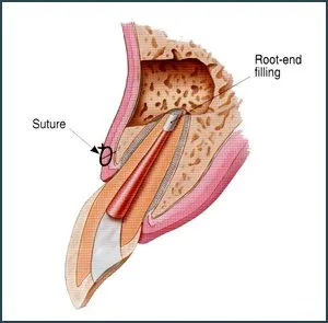 root-end filling