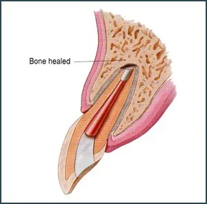 bone naturally heals around the root