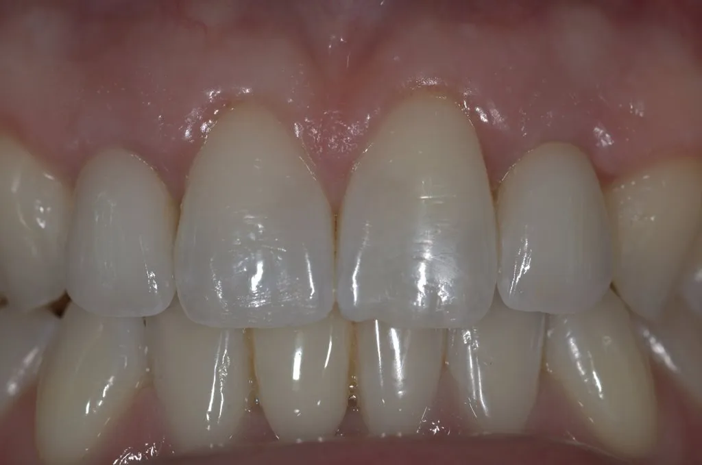 Implant Cases After