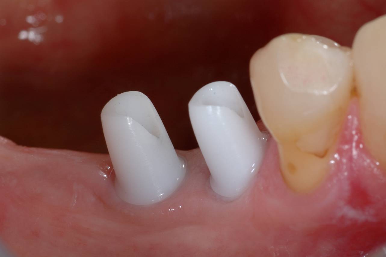Implant with ABUTMENT