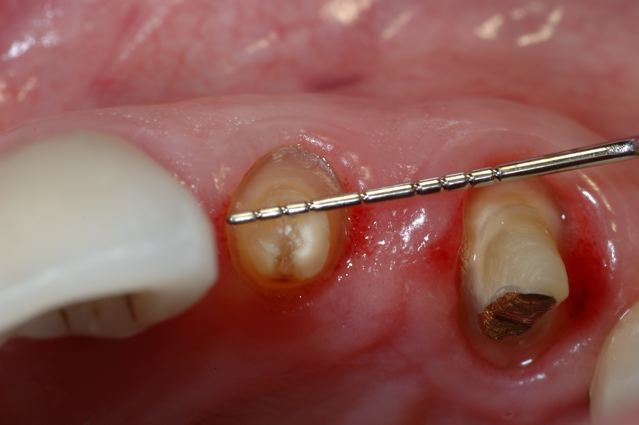 Implant Cases Before
