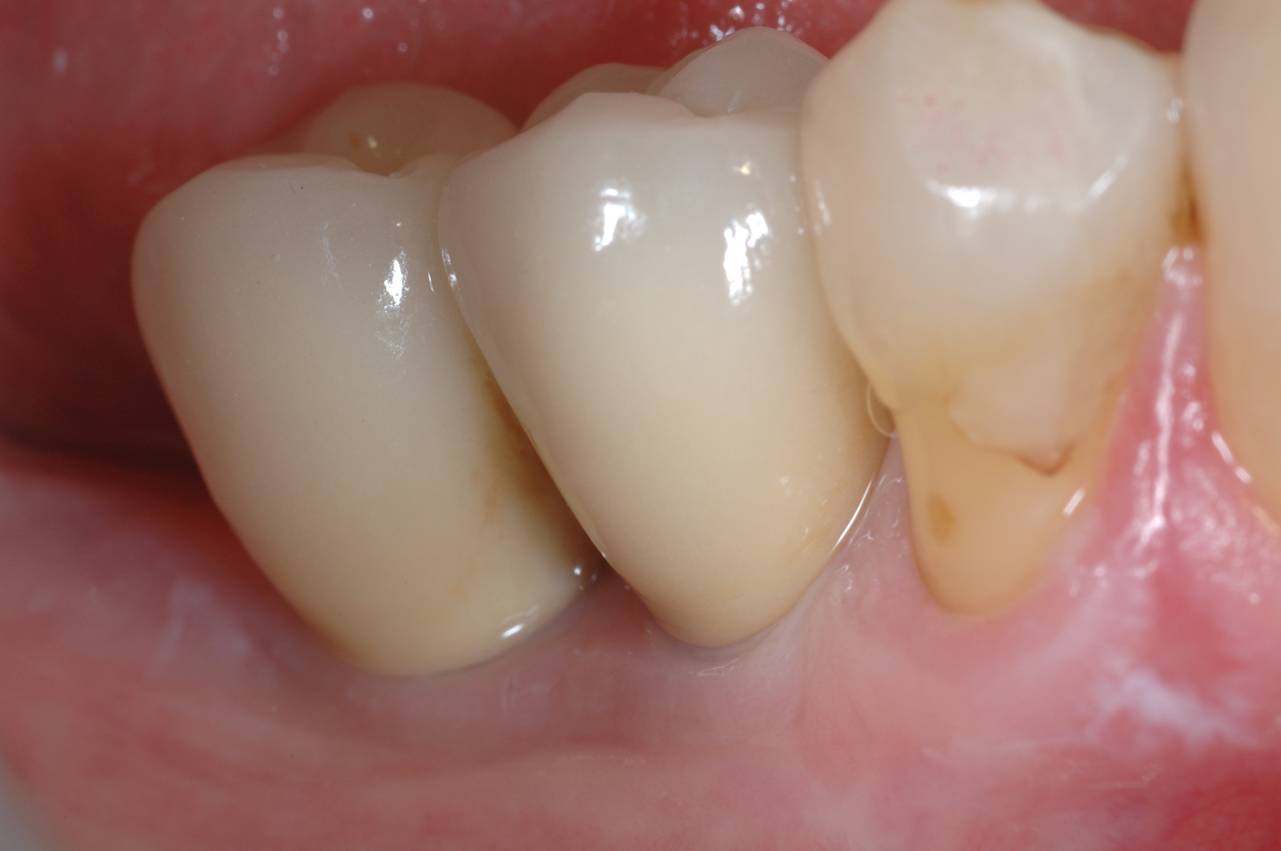 Implant Cases After