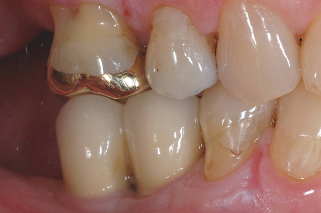 Implant Cases After