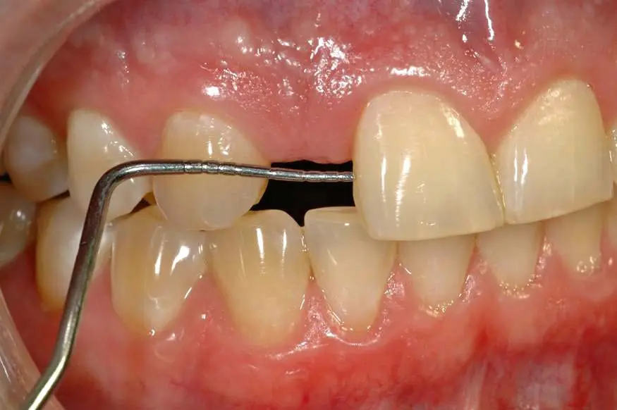 Implant Cases Before