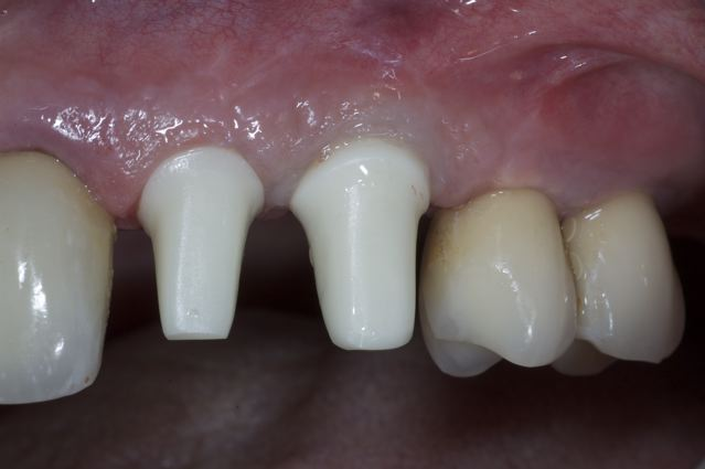 Implant with ABUTMENT