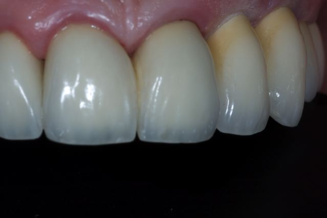 Implant Cases After