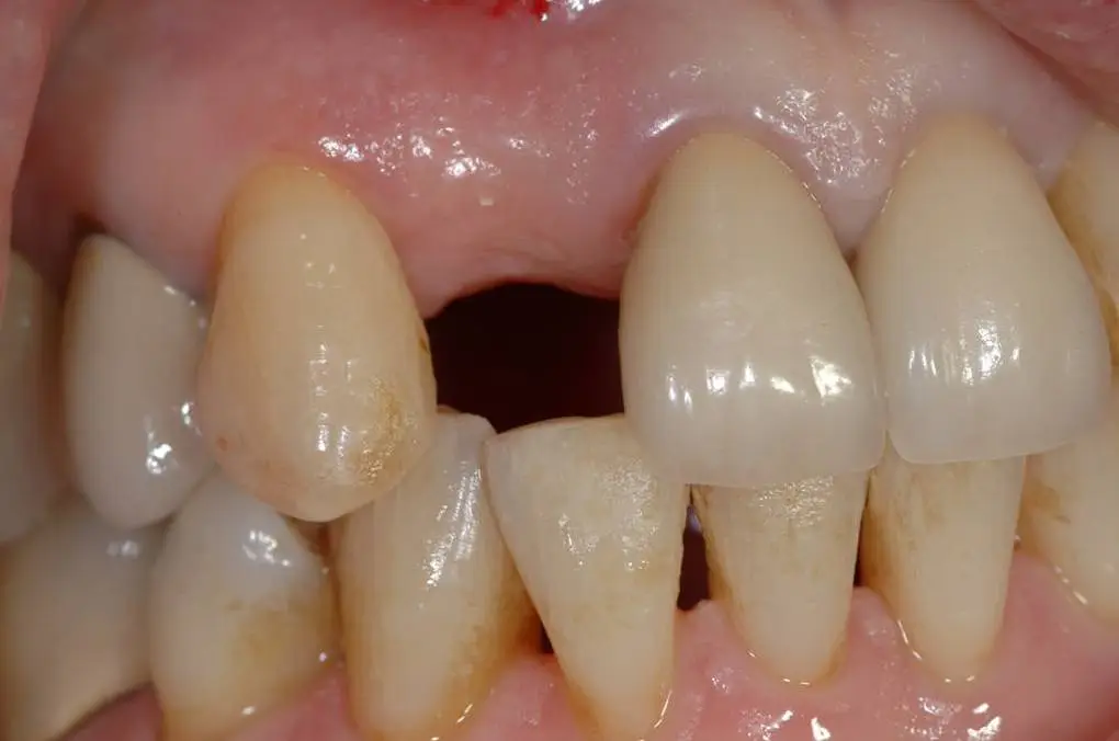 Implant Cases Before