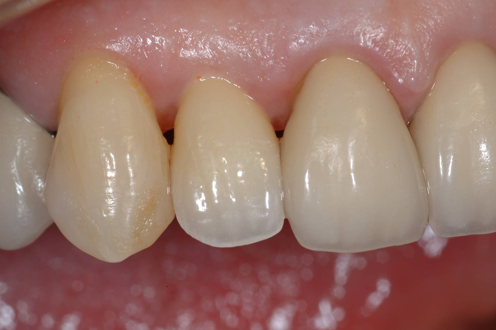 Implant Cases After