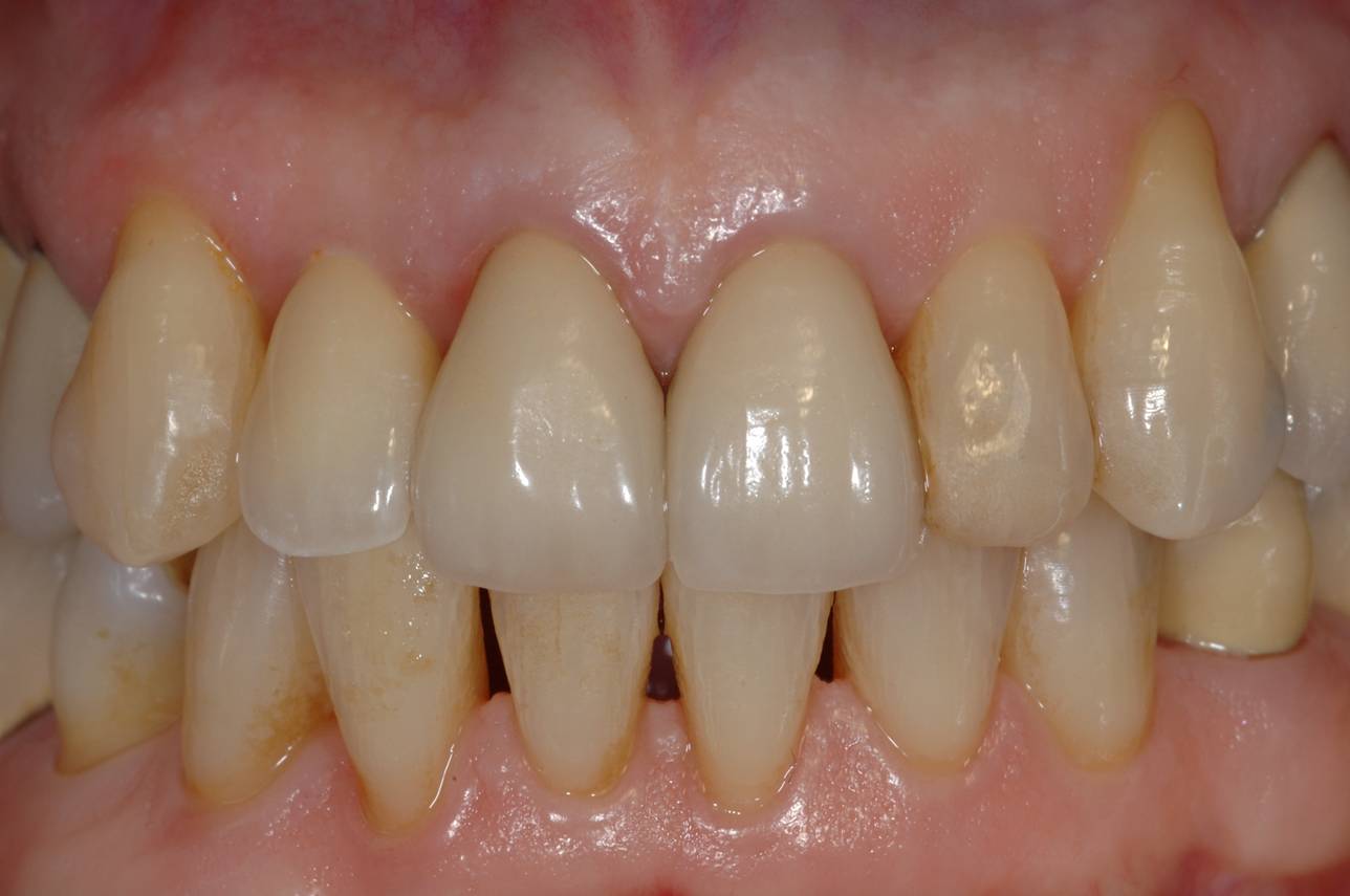 Implant Cases After