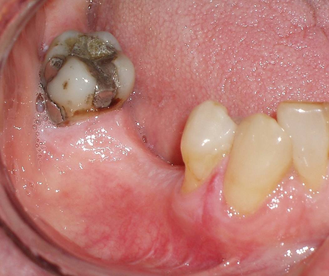 Implant Cases Before