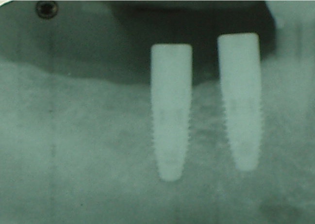 Implant Cases X-ray