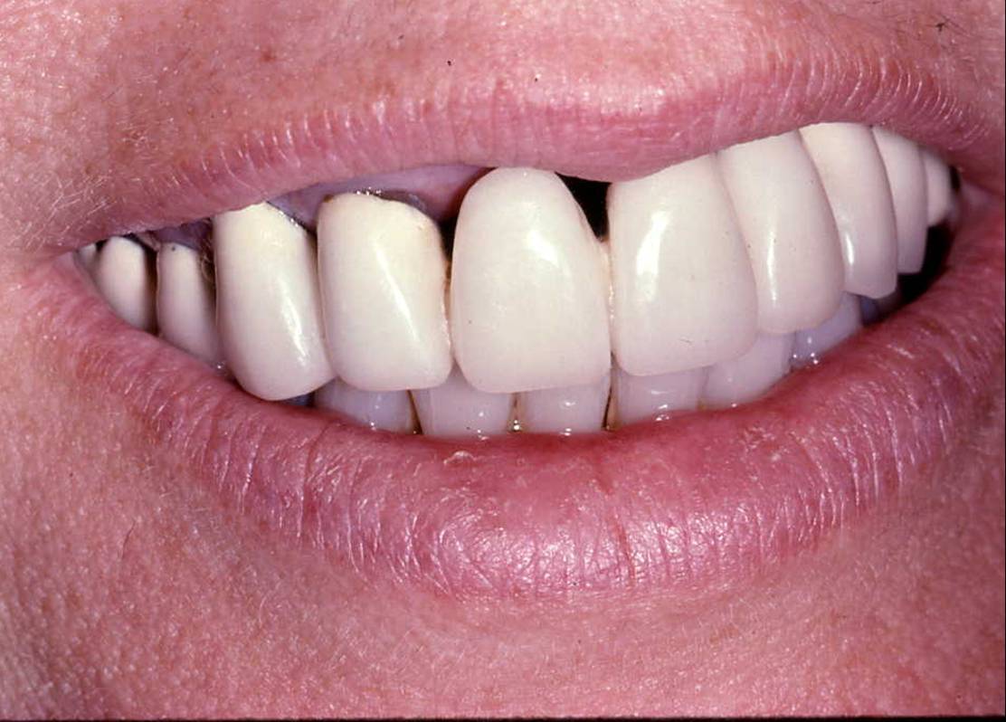 Implant Cases After