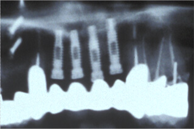 Implant Cases X-ray