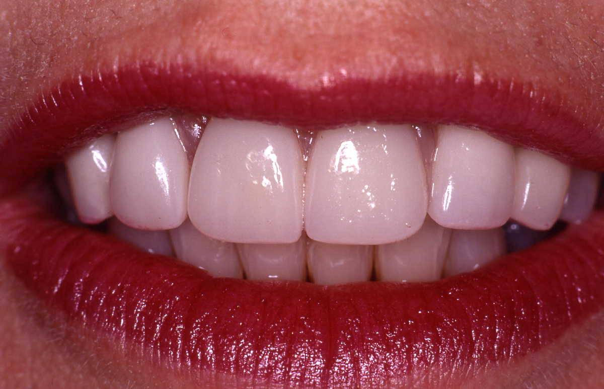 Implant Cases After