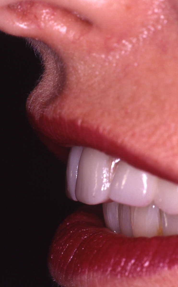 Implant Cases After