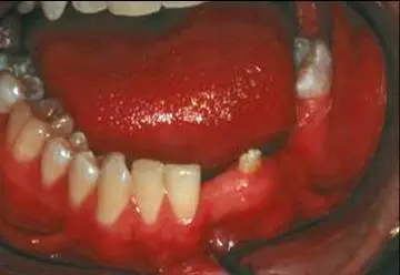 Implant Cases Before