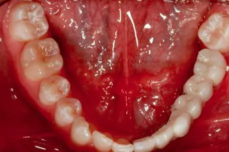 Implant Cases After