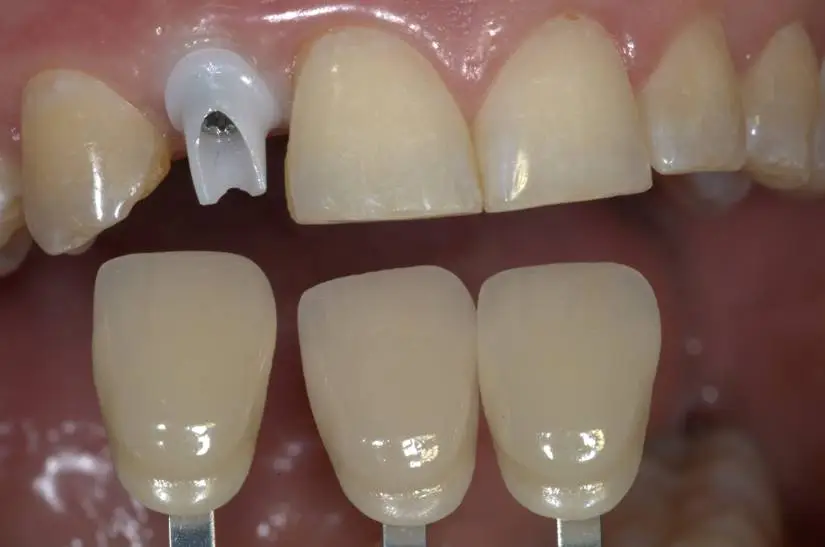 Implant with ABUTMENT