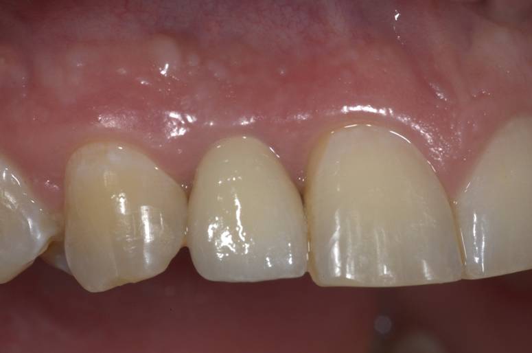 Implant Cases After