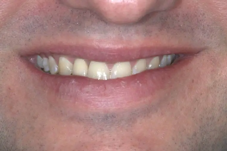 Implant Cases After