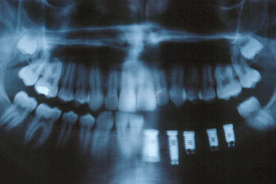 Implant Cases X-ray