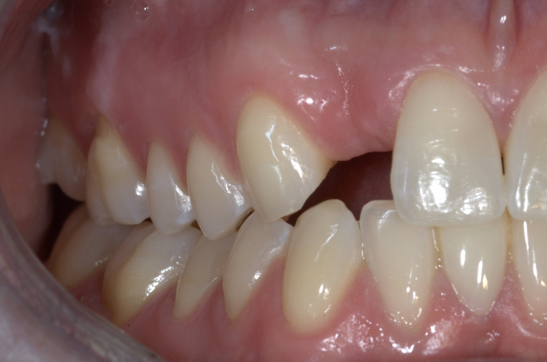 Implant Cases Before