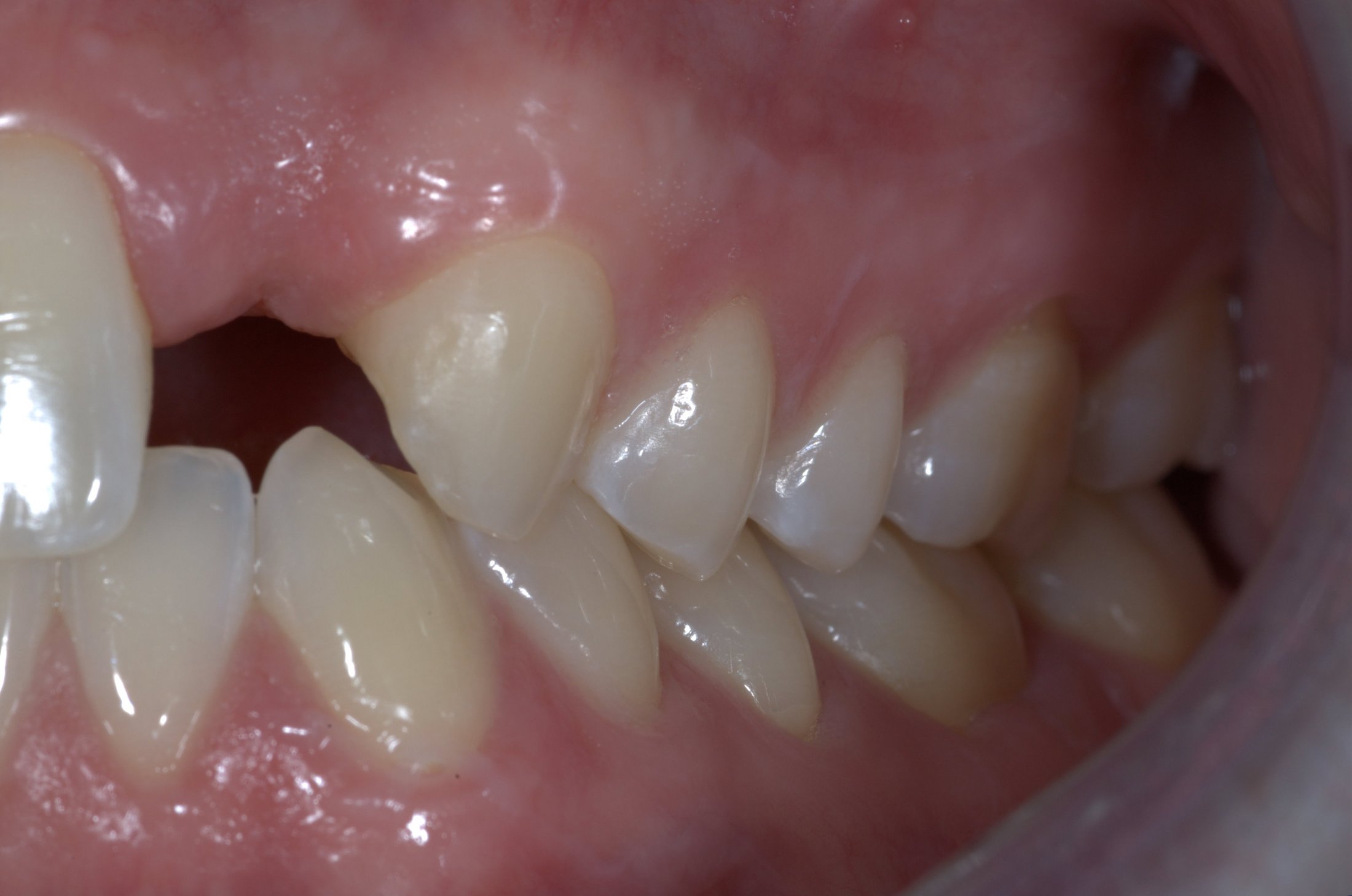 Implant Cases Before