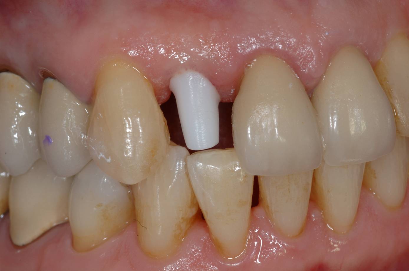 Implant with ABUTMENT